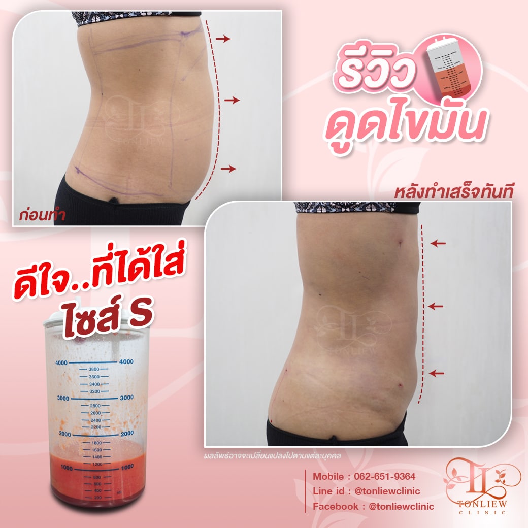 รีวิวดูดไขมันหน้าท้อง ต้นหลิวคลินิก