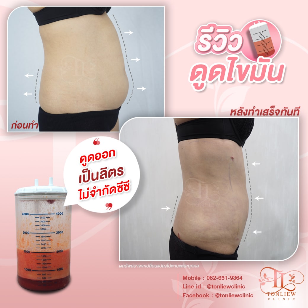 รีวิวดูดไขมันหน้าท้อง หมอหลิว