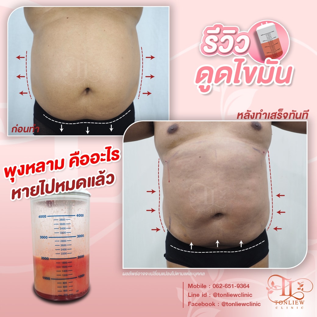 รีวิวดูดไขมันหน้าท้อง หมอหลิว