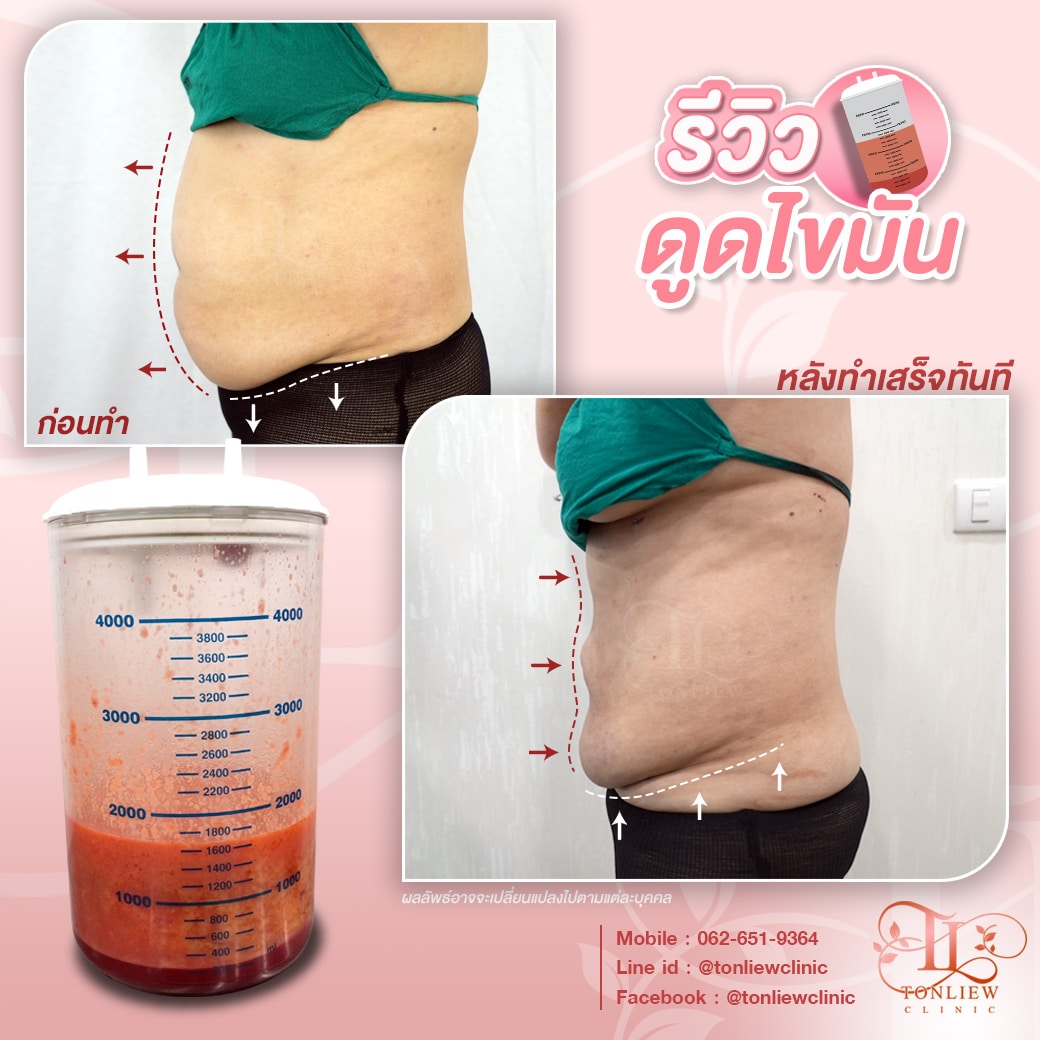 รีวิวดูดไขมันหน้าท้อง หมอหลิว