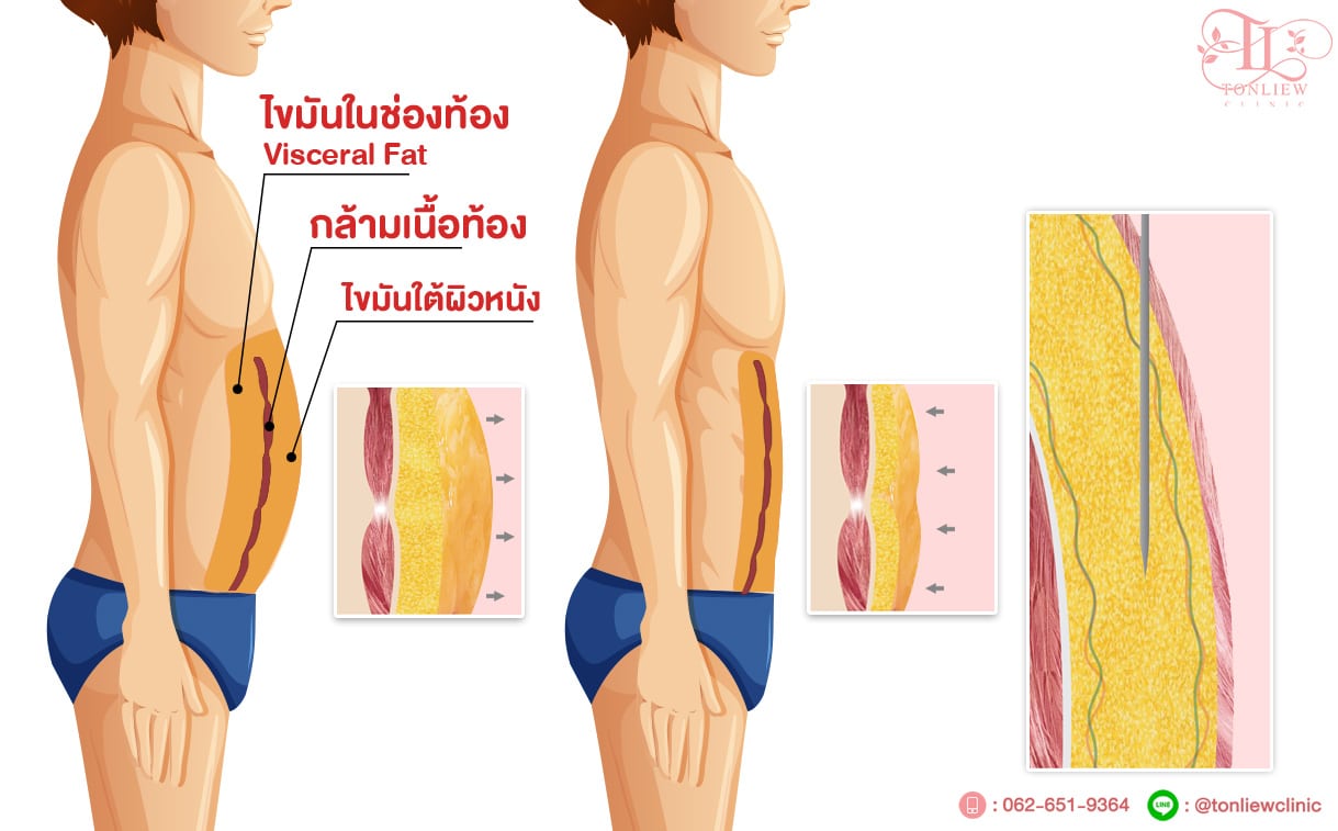 ดูดไขมันเพื่อทำ Six pack