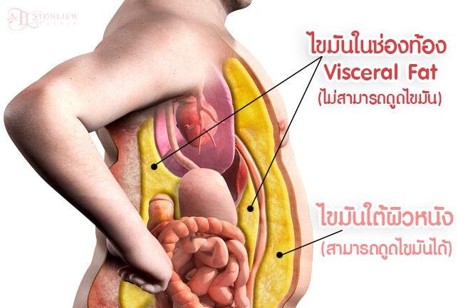 ไขมันในช่องท้อง visceral fat