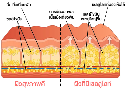 เทียบผิวสุขภาพดี และผิวเซลลูไลท์