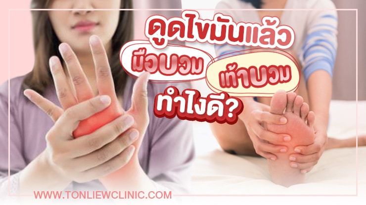 ดูดไขมันแล้วมือ-เท้าบวม ทำไงดี?