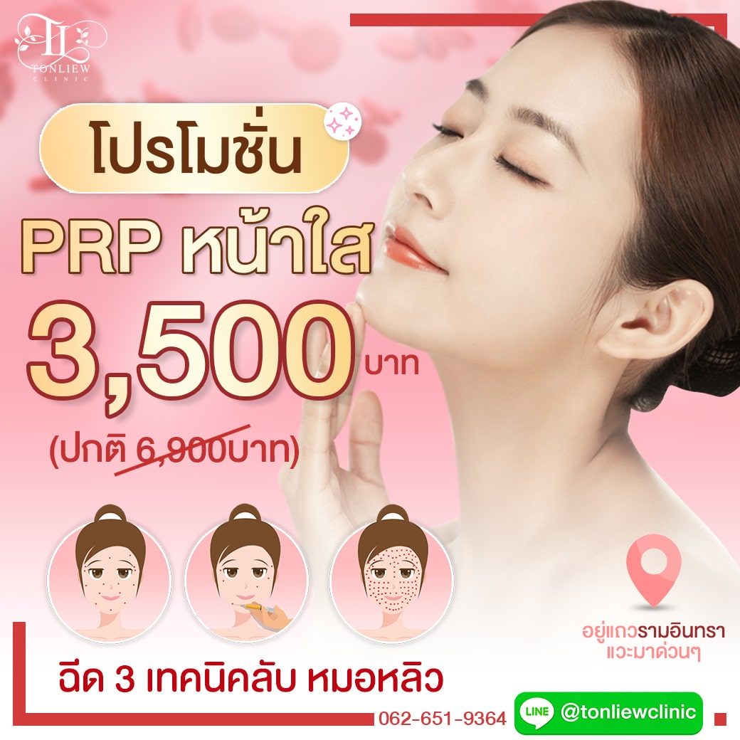 โปรโมชั่นฉีด PRP ราคา 3,500บาท