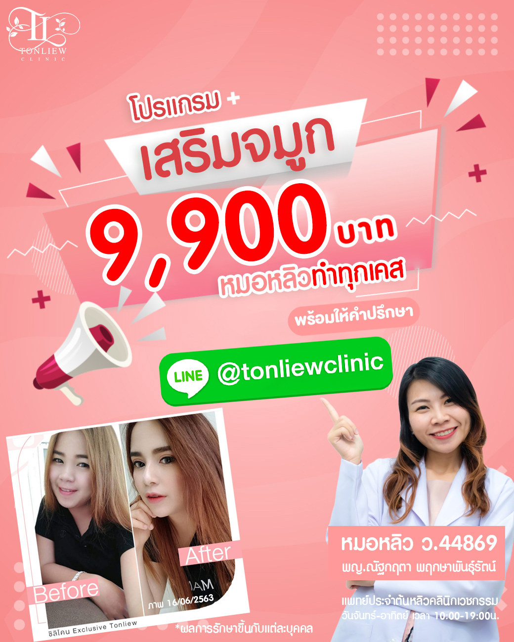โปรโมชั่น เสริมจมูกราคาถูก 9,900บาท ต้นหลิวคลินิก โหงวเฮ้งดี โปรโมชั่น เสริมจมูกราคาถูก 9,900บาท ต้นหลิวคลินิก โหงวเฮ้งดี
